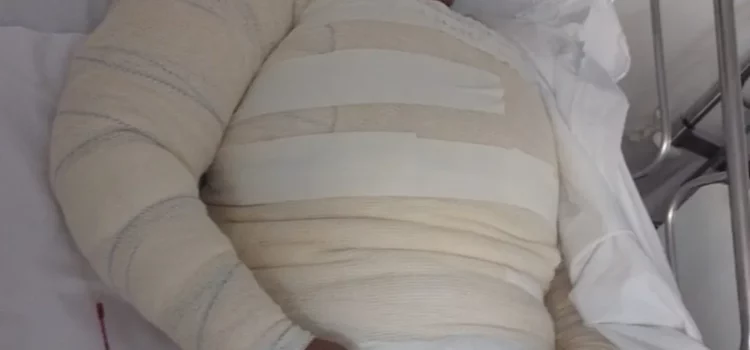 Mulher tem 50% do corpo queimado após ser atacada com água fervente em Santo Amaro