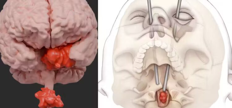 Cirurgia inédita retira tumor grave do cérebro pelo olho da paciente