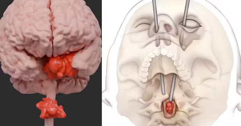 Cirurgia inédita retira tumor grave do cérebro pelo olho da paciente